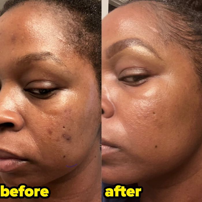 A reviewer's results after using Differin gel for five weeks, showing the before image with visible breakouts and hyperpigmentation on their cheek, and the after photo showcasing a significantly clearer face without breakouts or discoloration.
