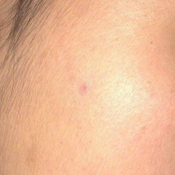 The same reviewer, now with no pimple, only a small healing mark left behind.