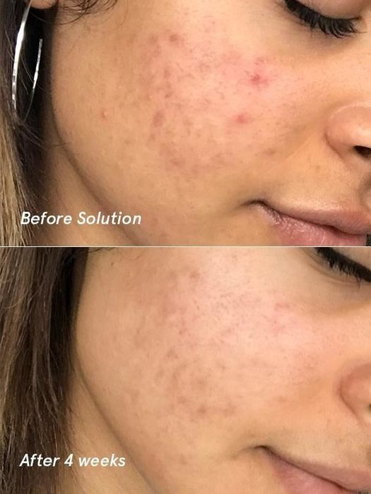 An image showing the transformation after four weeks, highlighting the improvement in acne and reduction in acne marks.