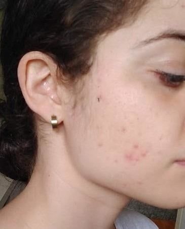 A reviewer displaying acne on their cheeks.