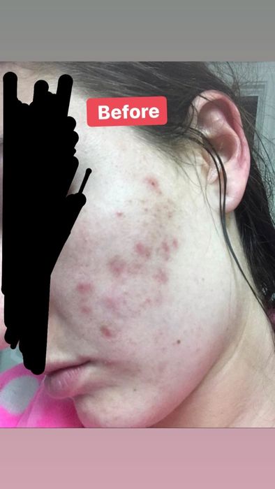 A reviewer's initial photo showing cheek acne and redness.