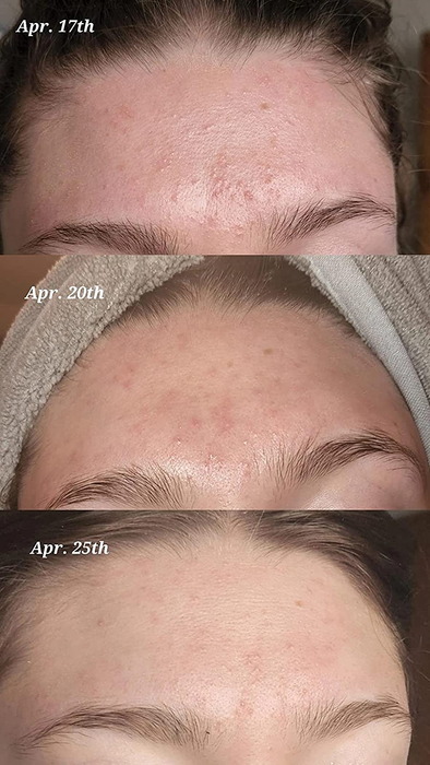 A reviewer's forehead on April 17th, 20th, and 25th, displaying reduced bumps and acne in the latter two images.