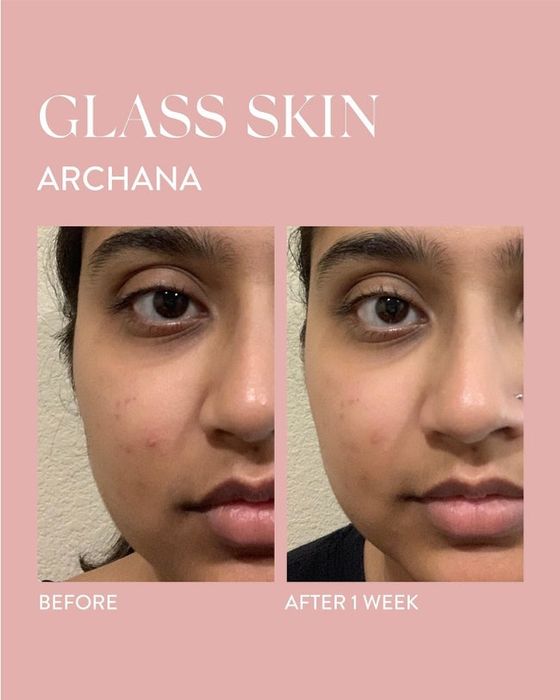 A before-and-after comparison illustrating the reduction in acne after just one week of use.