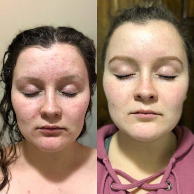 A before-and-after image of a reviewer, showing reduced redness and smaller acne bumps.