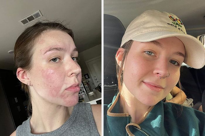 Before and after images from a reviewer showing redness visibly reduced on their face