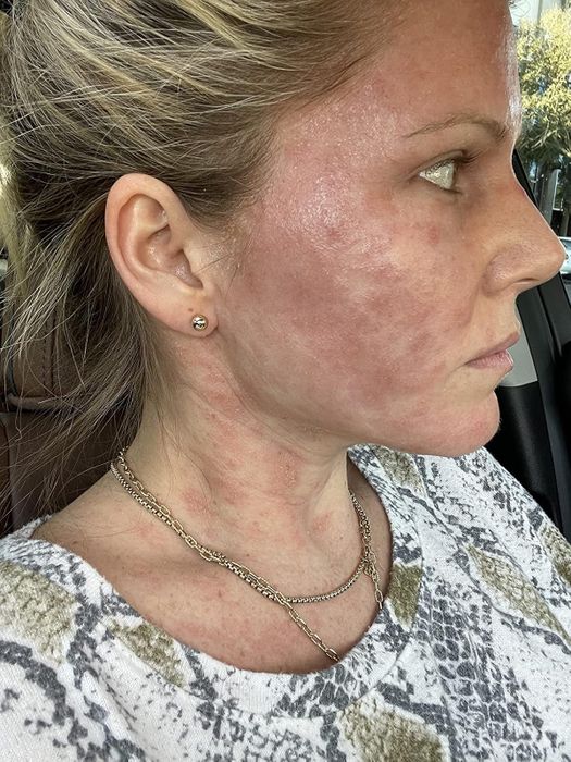 A close-up shot of a woman in a patterned shirt and chain necklace, highlighting her skin condition, possibly showcasing a skincare product or treatment in an article focused on shopping recommendations