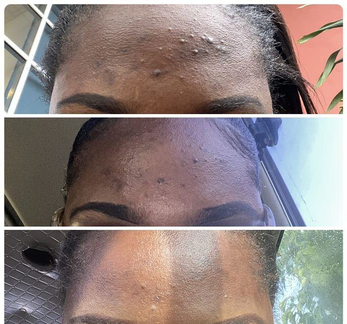 The reviewer’s forehead in the first photo shows cystic acne before using PanOxyl, in the second photo you can see improvement with reduced acne after starting the wash, and the third photo shows their skin fully cleared after consistent use