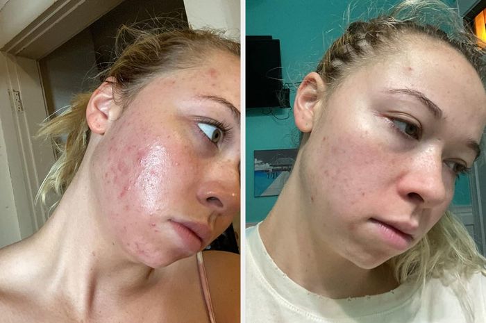 Side-by-side images display a woman with acne in the left photo and smoother skin with fewer blemishes in the right, showing the effectiveness of Differin Gel.