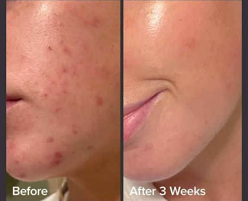 Side-by-side photos showing the same person’s face before, with acne and discoloration, and after 3 weeks of clearer skin. Text reads