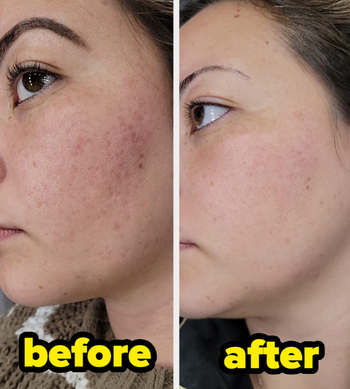 Before and after images showing the reviewer’s skin transitioning from irritated to clear