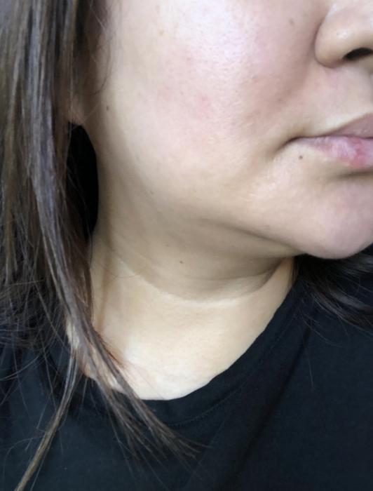 The same individual with all the scars on their chin completely healed.