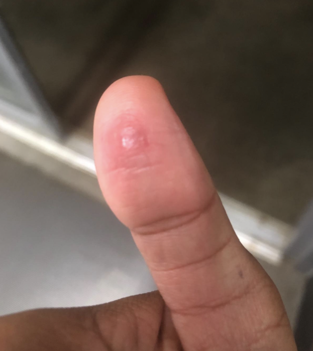 The same reviewer demonstrates the wart nearly gone after using the pads.