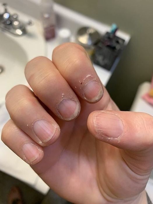A reviewer displaying their dry, cracked cuticles before applying the serum.