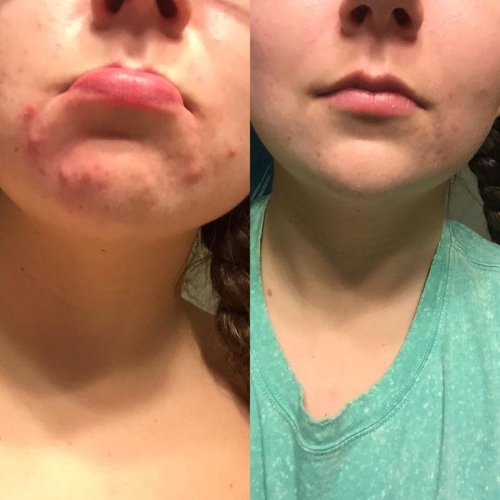 A reviewer's before and after photos, showing a significant reduction in acne from the first image to the second.