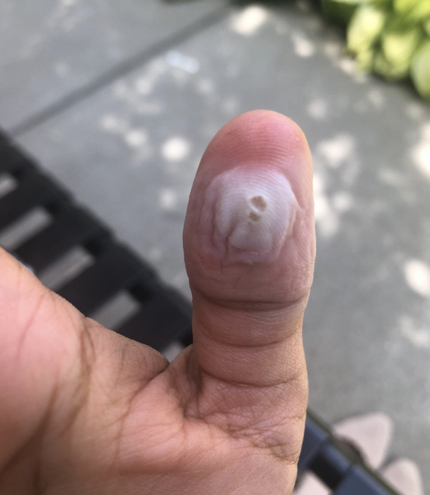 A reviewer shows a wart on their thumb.