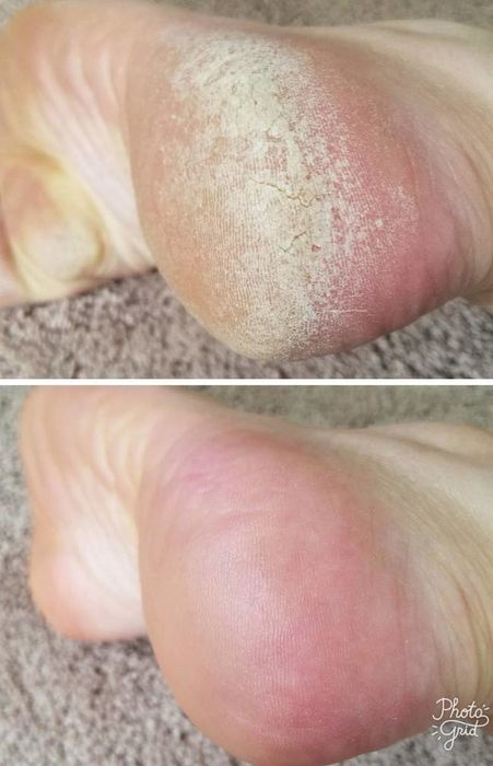 The reviewer's photo showing a dry, calloused heel and then a heel that looks smooth and well-moisturized.