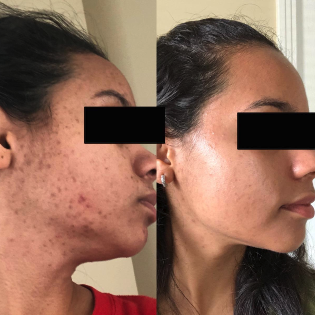 A comparison between a before and after photo, showcasing acne scars in the first image and a noticeable reduction in scarring and dark spots in the second.