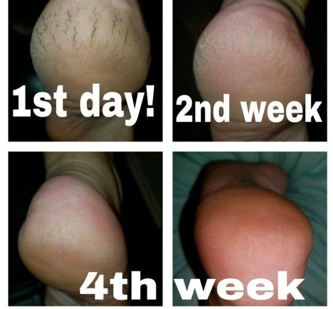 A sequence of photos taken over four weeks showing the progress of using the effective foot cream.