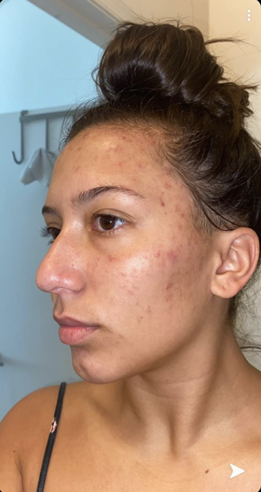 A reviewer with noticeable acne breakouts on their cheek and forehead.