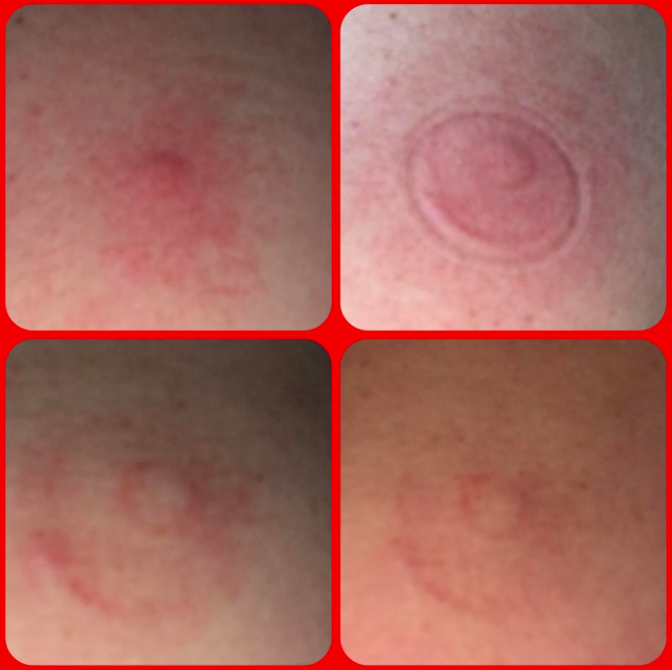 A photo from the reviewer showing the bite area after using the tool, highlighting the changes over time.