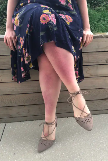 The author's sunburned legs.
