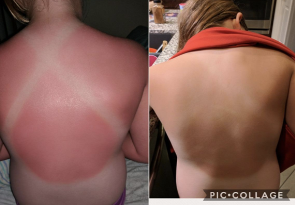On the left: a severely sunburned back of a reviewer, and on the right: the same back after healing with a nice tan.