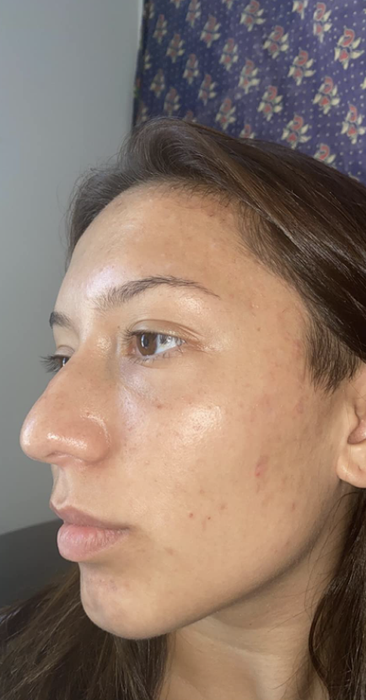 The same reviewer shows their face, now with healing breakouts and a lighter appearance.