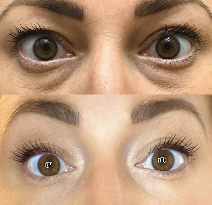 Person demonstrating results before and after using Maybelline Age Rewind Concealer