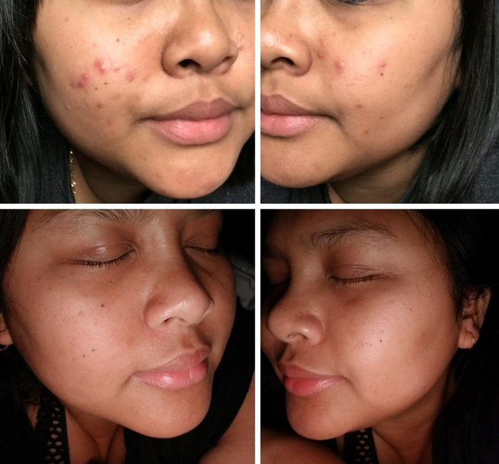 A reviewer's before-and-after photos showcasing diminished acne scars and a more even skin texture