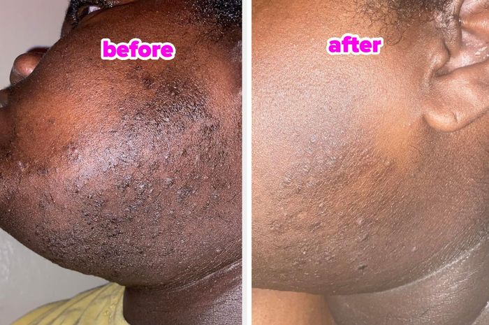 the reviewer before and after using the toner pads to clean up ingrown hair bumps