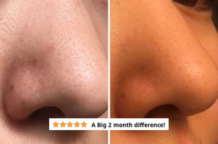 A nose displaying fewer blackheads after two months of use
