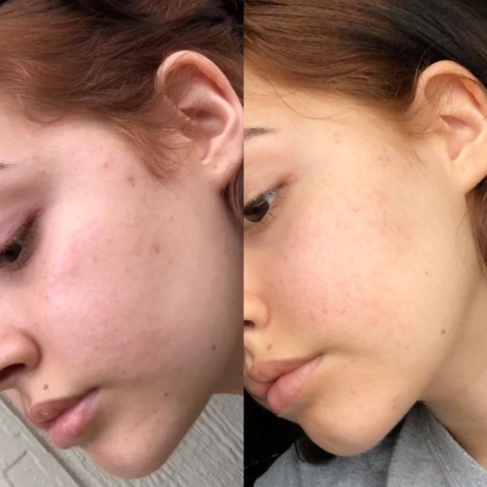 A before-and-after comparison showcasing the visible improvements in a person’s skin, likely due to a skincare product
