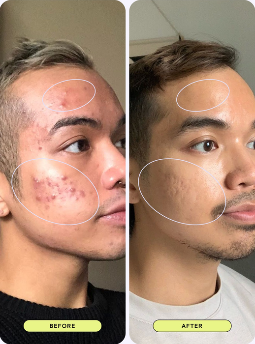 A split-image comparison of a man’s face before and after skincare treatment, emphasizing a noticeable reduction in acne and enhanced skin texture