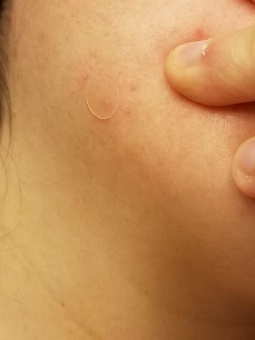 A pimple patch placed on the cheek of a reviewer