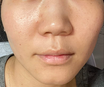 After image of a reviewer showing clearer and more even-toned skin