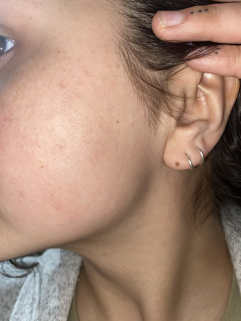 After photo showing fine hairs removed from the face
