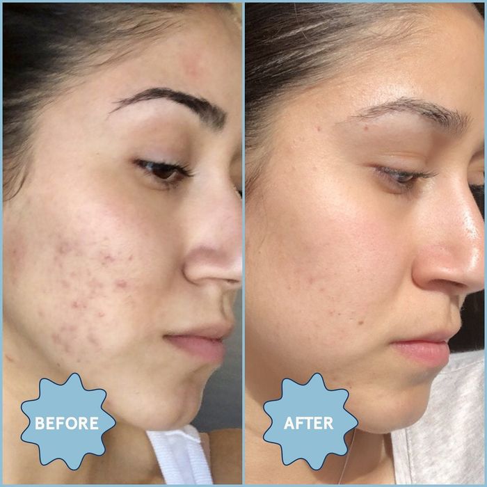 Before-and-after images showcasing the healing of acne.