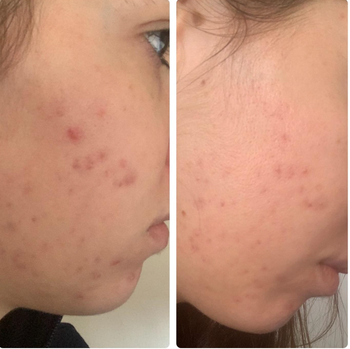 A reviewer's before-and-after photos showing red acne in the first image and significantly faded acne in the second.