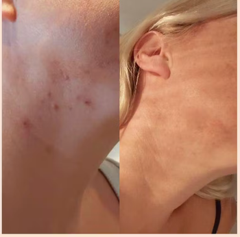 A reviewer's before-and-after photos showing a noticeable reduction in acne after using the face scrub.