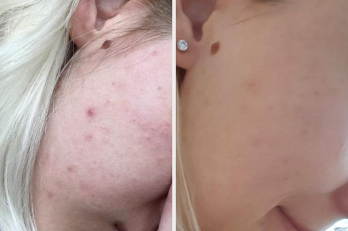 Before-and-after image showing the reviewer's acne-prone skin now smoother and more even-toned