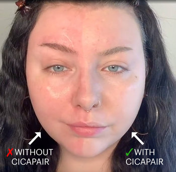 Model showing one side of their face without the treatment and the other side with reduced redness and a more even tone