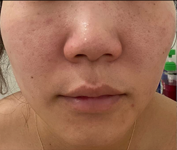 Before image of a reviewer showing redness in their skin