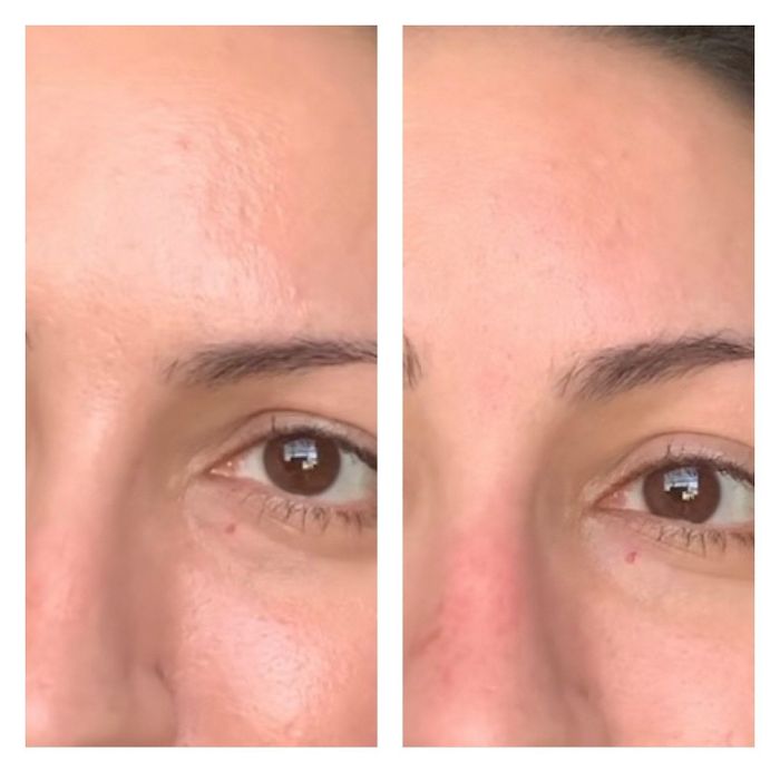 A reviewer demonstrating the results of using the Revlon volcanic facial roller.