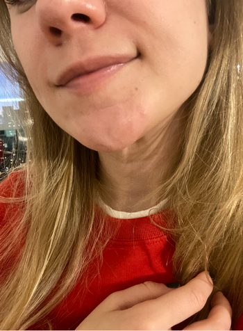 The same chin with a significantly reduced and less inflamed zit.