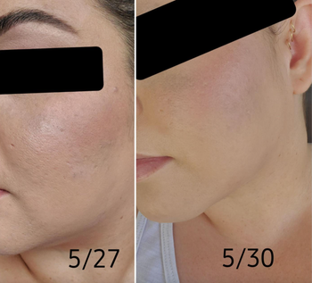 Before-and-after photo of a reviewer showing visibly smoother skin after just three days of use
