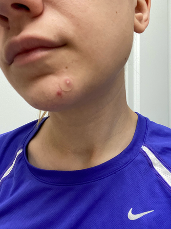 An individual using a pimple patch to draw out impurities from a zit on their chin.