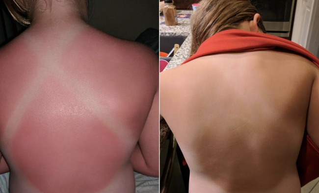 A reviewer's image of a sunburned back and a healed one.