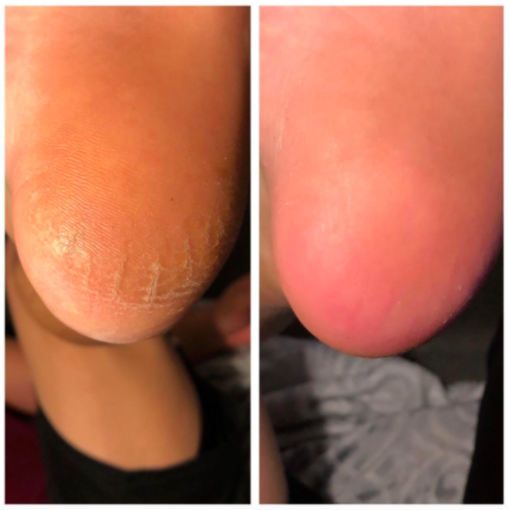 A photo from the reviewer displaying before-and-after images of their heel, transitioning from dry and cracked to glossy and smooth after using the Colossal foot rasp.