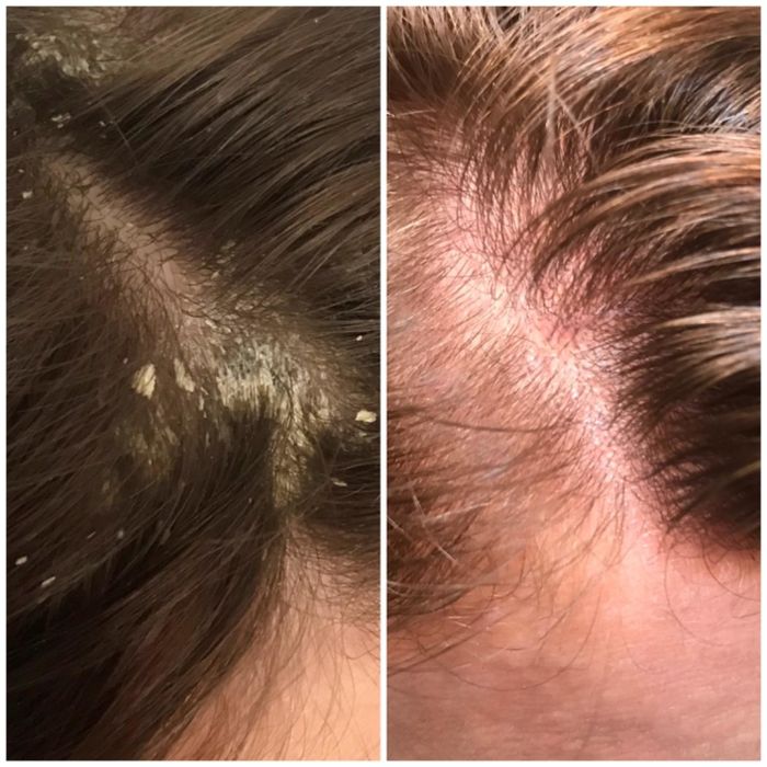 A reviewer showing large dandruff flakes that disappeared after using the shampoo
