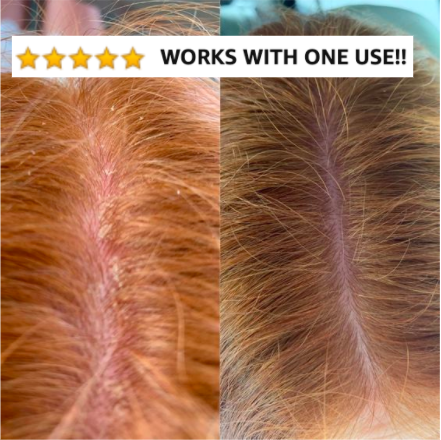 Reviewer showing before-and-after images with dandruff, followed by a clear scalp with the text 'Works with one use!!' overlayed.